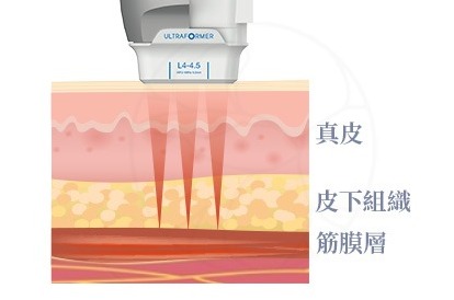 音波拉提 作用機制示意圖