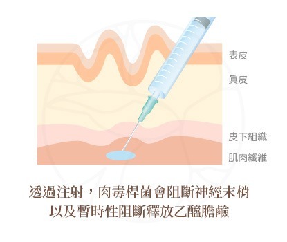 肉毒桿菌會阻斷神經末梢、釋放乙醯膽鹼