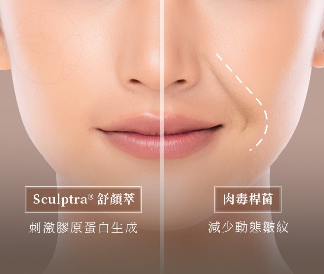 舒顏萃 Sculptra® 能刺激膠原蛋白生成而肉毒桿菌則是能夠減少動態皺紋