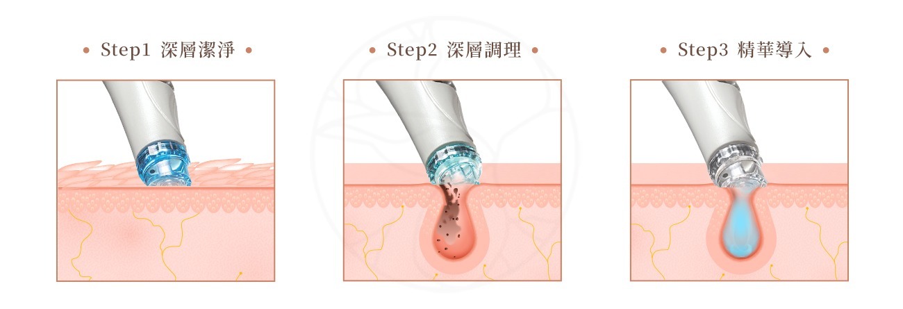 水飛梭是一種先進的無創美容療程，融合了最新的皮膚護理技術。這種治療使用特殊的漩渦式設備，通過多個步驟來清潔毛孔、去除老廢角質，並為皮膚補充營養。 水飛梭療程特色在於獨特的功能設計，能吸出髒污並同時將營養注入肌膚，也就是說水飛梭不僅能深入清潔肌膚，還可以立即為肌膚補水、提供養分，特別適合需要深層清潔卻擔心刺激的敏感肌。