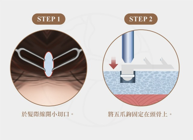 步驟1 於髮際開小切口  步驟2 將五爪鉤固定在頭骨上