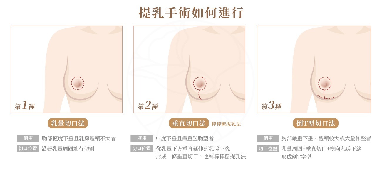 提乳手術依個人狀況可分為3種切口, 第1種乳暈切口法, 第2種垂直切口法, 第3種倒T型切口法