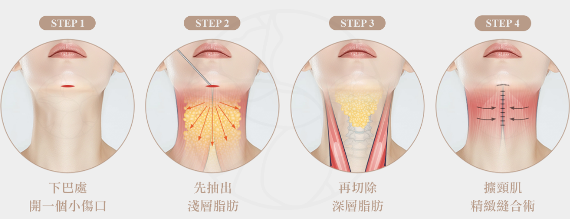 步驟1 下巴處開1個小傷口  步驟2 先抽出淺層脂肪 步驟3 再切除深層脂肪, 步驟4 擴頸肌精緻縫合術