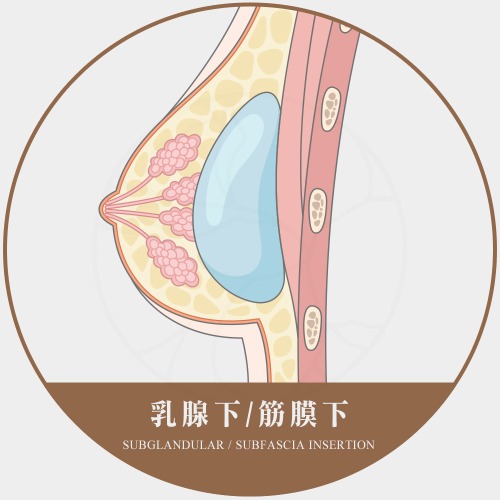 隆乳假體放置層次選擇 乳腺下/筋膜下