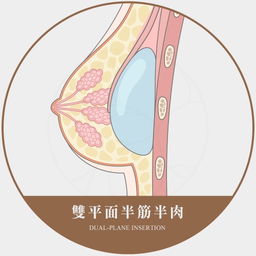 隆乳假體放置層次選擇 雙平面半筋半肉