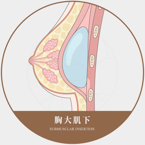 隆乳假體放置層次選擇 胸大肌下