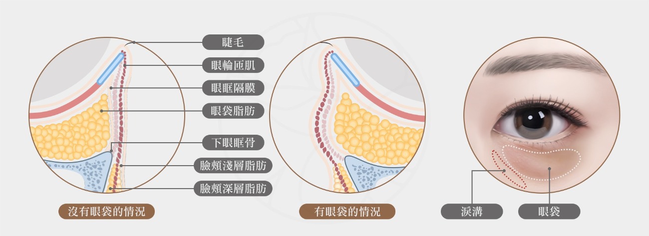 有眼袋時有明顯的淚溝且眼袋脂方膨出, 沒眼袋時眼下脂肪平緩