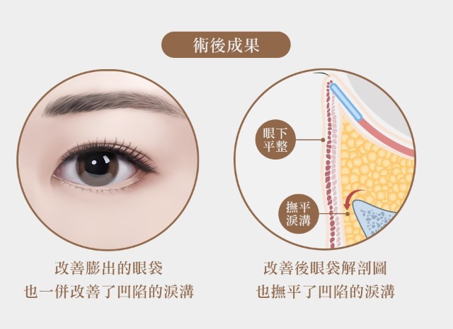 眼袋術後成果能明顯改善膨出的眼袋及凹陷的淚溝