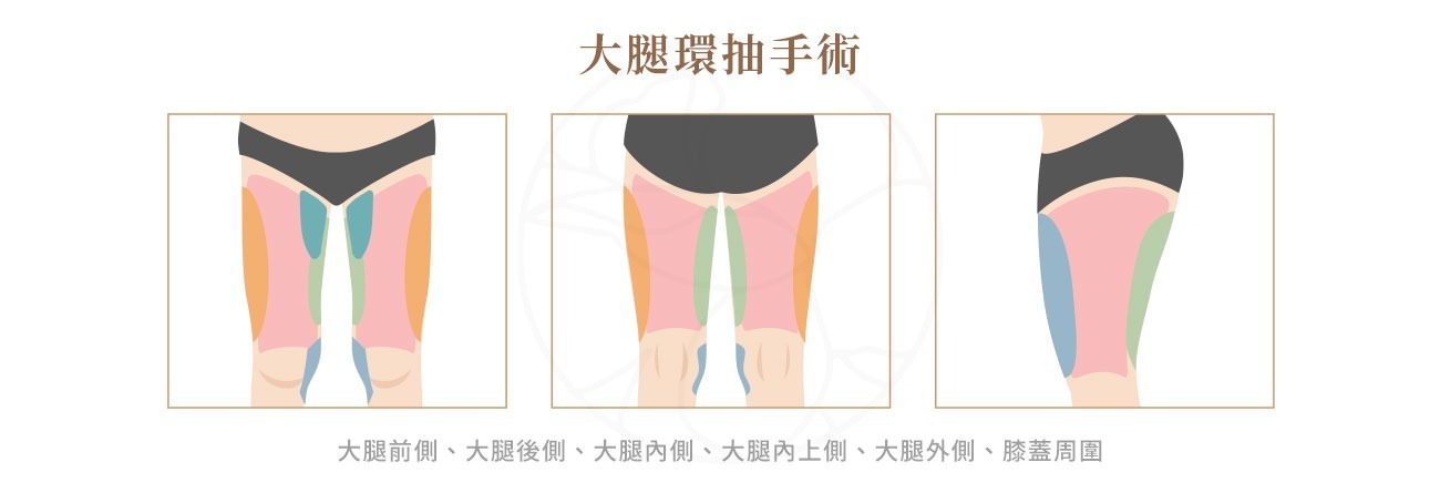 大腿環抽手術部位