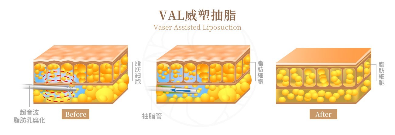 VAL (Vaser Assisted Liposuction) 威塑抽脂  這是新型精準的抽脂儀器，可以理解為第三代的超音波抽脂技術。其技術是利用末端有凹槽的金屬棒發出脈衝形式的超音波，在注入膨脹液後，經過約10到15分鐘對脂肪層進行處理，使脂肪組織變軟，然後再插入吸脂管 (cannula)來移除脂肪。