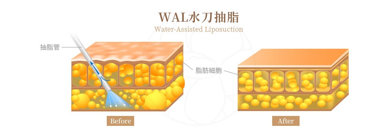 WAL(Water-Assisted Liposuction) 水刀抽脂 水刀抽脂是2000年代出現的技術。它的原理是通過從導管末端噴射出強力的水流來分解脂肪。這種手術的最大優點是對組織的損傷最小。超音波或雷射技術是通過溶解脂肪組織進行分解，因此不可避免地會對組織造成一定程度的損傷，但水刀抽脂是依賴純粹的水壓來分解脂肪層。因此，手術後的疼痛感相比其他技術要少得多。