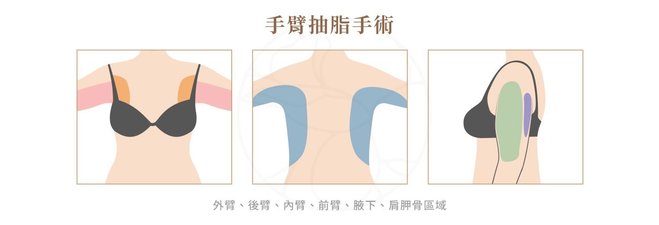 手臂抽脂手術部位