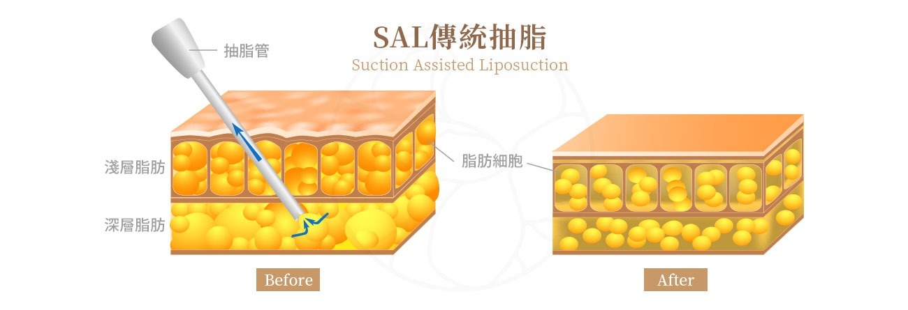 SAL (Suction Assisted Liposuction) 傳統抽脂  傳統抽脂是最基本的抽脂手術方法，因此也被稱為「傳統抽脂法」或稱為「經典抽脂法」。