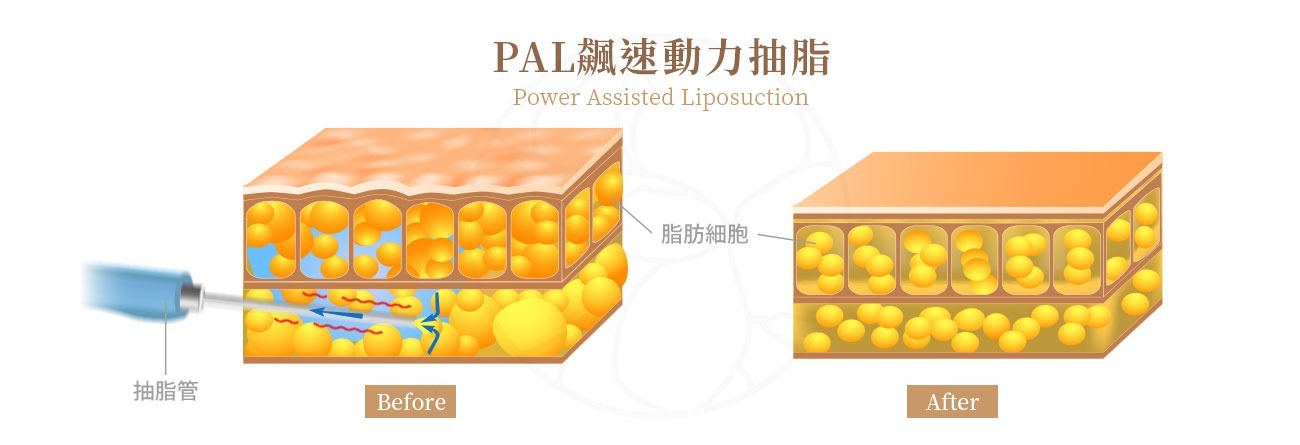 PAL (Power Assisted Liposuction) 飆塑動力抽脂 原理：利用機械力讓吸脂管 (cannula)每分鐘自動轉速約4,000次，幅度為2-5毫米，這大大提升了抽脂的效率，對於組織傷害小、瘀血狀況也大幅降低。