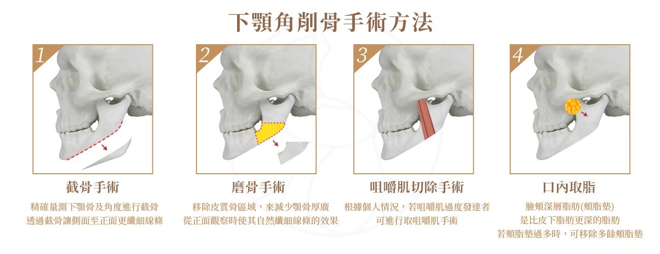 下顎骨削骨手術方式包含,截骨手術,磨骨手術,咀嚼肌切除手術,口內取脂