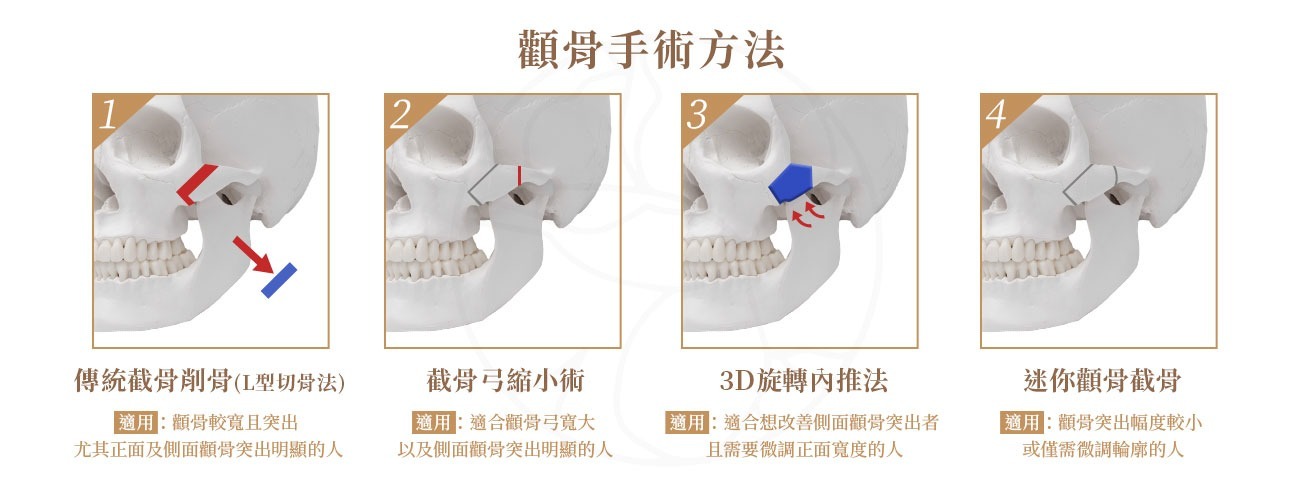 顴骨手術方法包含傳統截骨削骨法(L型切骨法), 截骨縮小術,3D旋轉內推法,迷你顴骨截骨