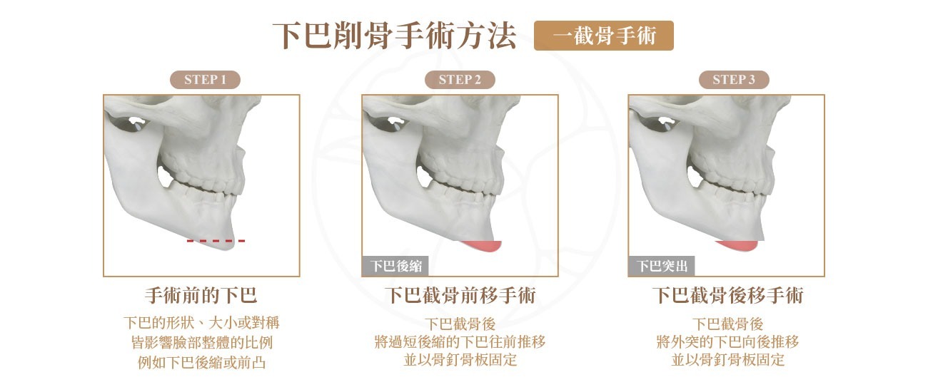 下巴削骨手術 一截骨手術