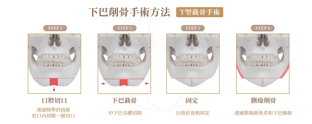 下巴削骨手術 T型截骨手術