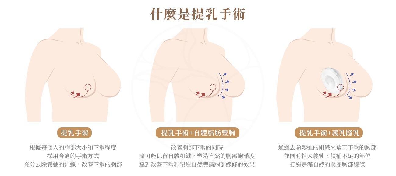 提乳手術（乳房上提手術）主要針對因年齡增長、產後哺乳、重力拉扯或減重等因素導致的乳房下垂問題。透過手術將鬆弛下垂的乳房皮膚及組織進行重塑，改善乳房位置與形狀，讓胸部恢復自然緊緻的外觀。除了提乳手術之外, 也依個人需求搭配自體脂肪豐胸或義乳隆乳。