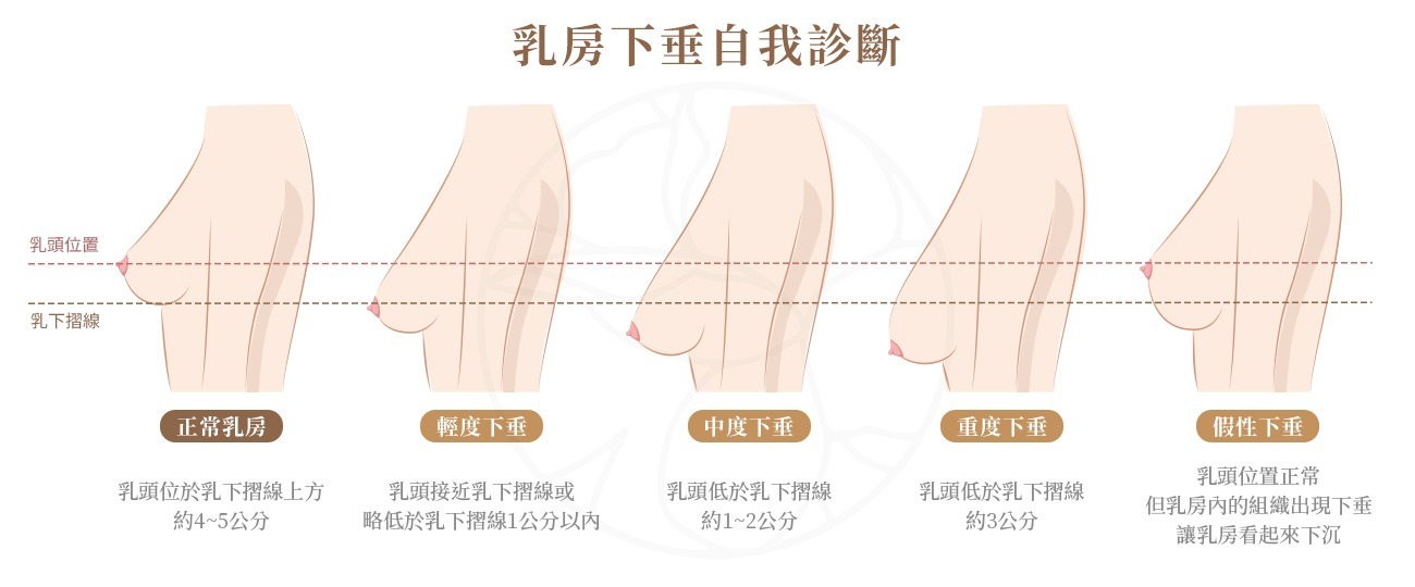 在一般情況下，對於未出現下垂的乳房，亞洲人體型的乳頭通常位於乳下摺線上方約 4-5 公分處。然而，當乳頭逐漸下降，與乳下摺線的距離縮小時，可依據下垂程度進行分類，從輕度下垂（約 1 公分）至重度下垂（約 3 公分）。此外，還存在一種稱為假性下垂的情況，即乳頭仍位於乳下摺線上方，但乳房的下部組織出現鬆弛或下垂，使乳房視覺上呈現下沉的狀態，乳房下緣可能位於乳下摺線附近。從乳房結構來看，此類情況無明顯乳頭下垂，但可能影響上半身的整體比例與美觀。